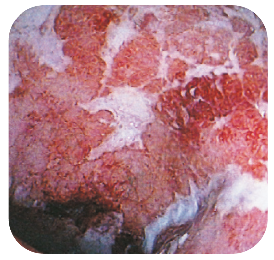 Bild 4. Oregelbunden, ställvist eroderad slemhinna med fibrinexsudat vid kroniskt aktiv obestämbar kolit.