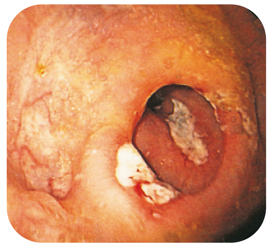 Bild 13. Anastomosulcus och djupa ulcerationer även i neoterminala ileum hos CD-patient opererad med ileocekalresektion.