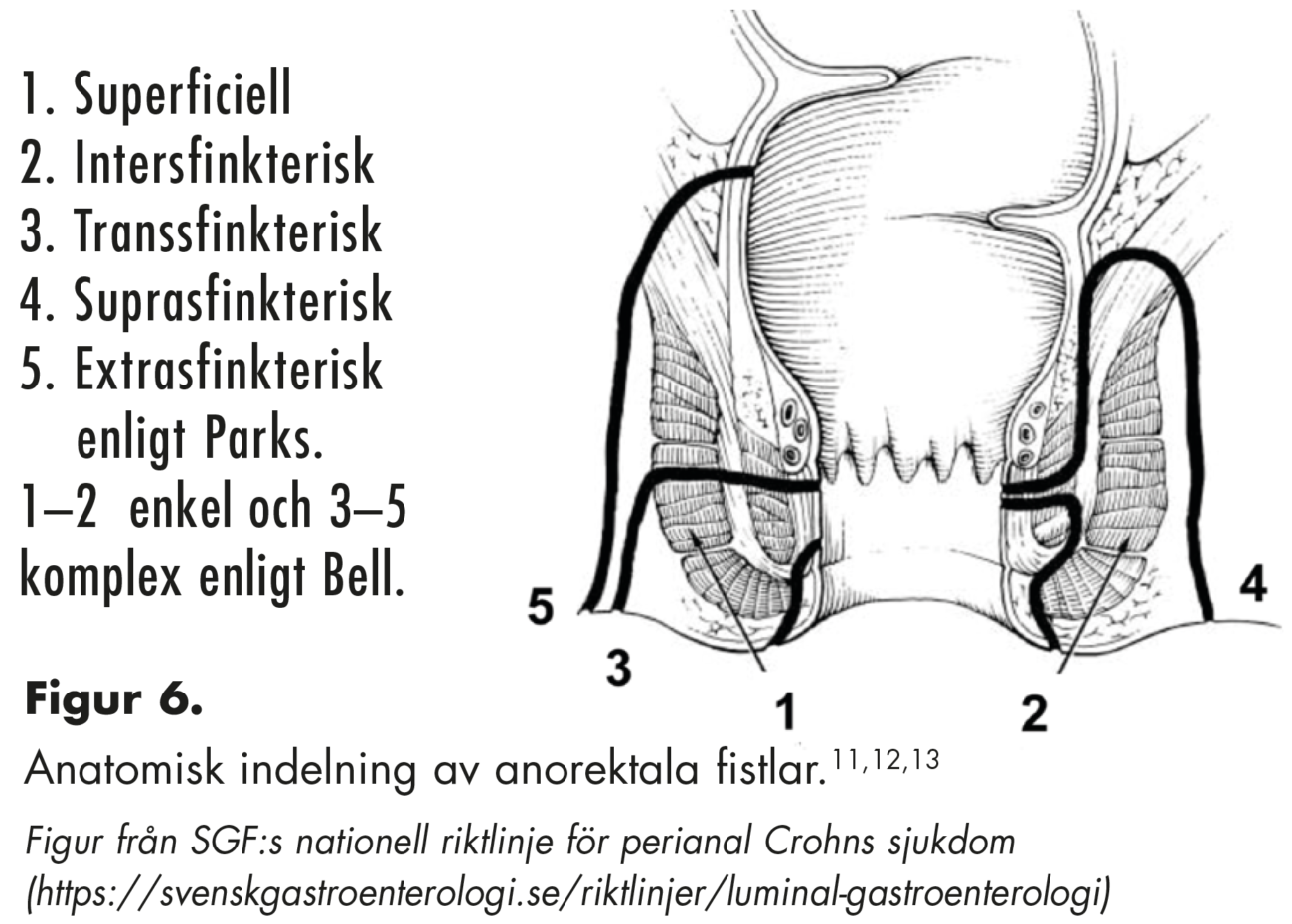 Figur 6. Anatomisk indelning av anorektala fistlar
