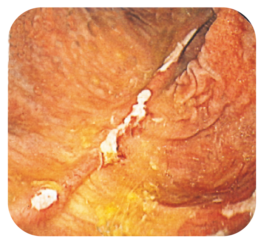 Bild 16. Tydliga anastomoslinjer med ställvist förekommande fibrinbeslag i bäckenreservoir hos patient med CD som ursprunglig diagnos.