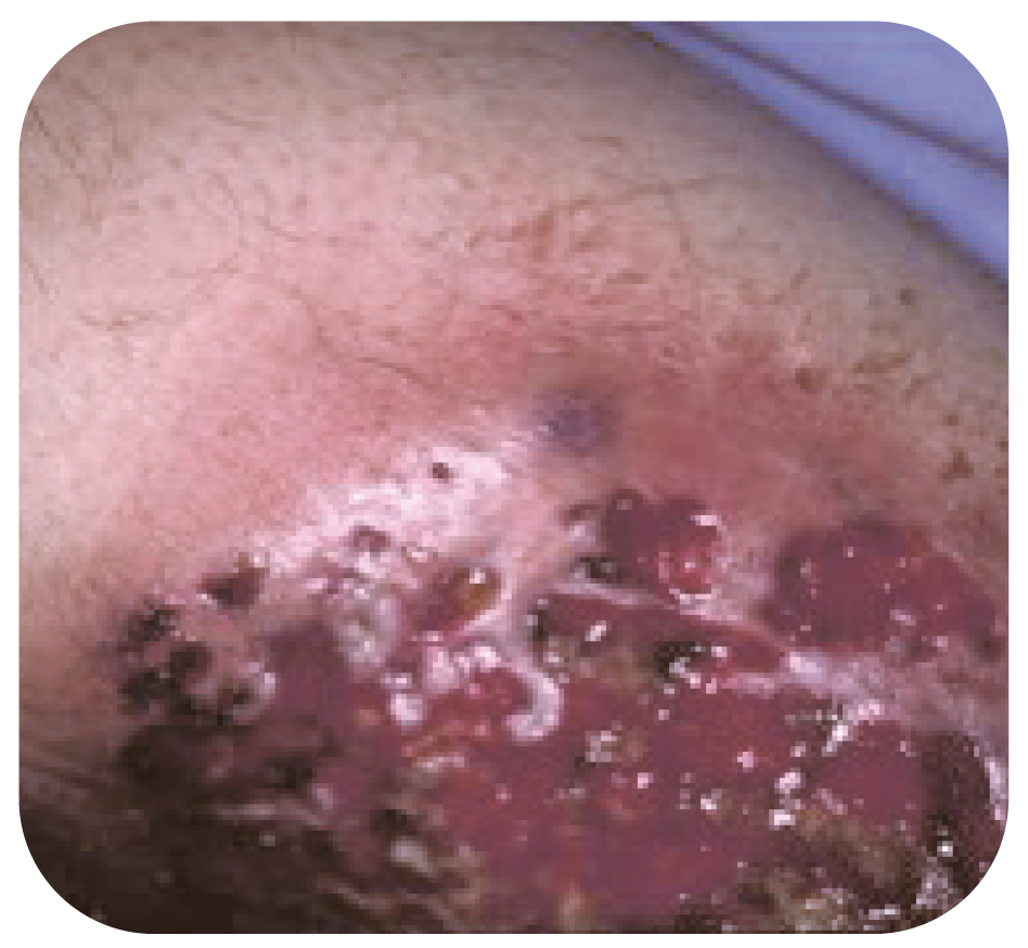 Bild 17. Pyoderma gangrenosum.