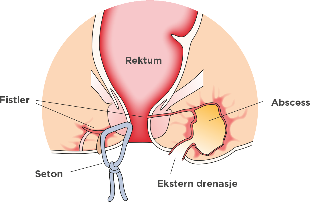 Komplikasjoner rektum fistler seton ekstern drenasje abcess