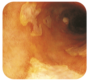 Bild 6. Oregelbundna, flacka, fibrinbelagda ulcerationer vid CD.