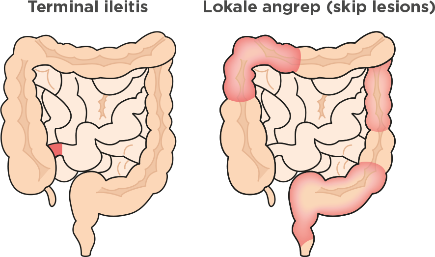 Terminal ileitis - Lokale angrep (skip lesions)