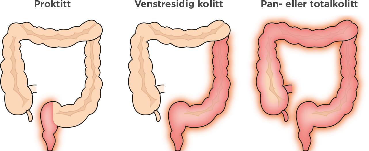 Prokitt, venstresidig kolitt, pan eller totalkolitt